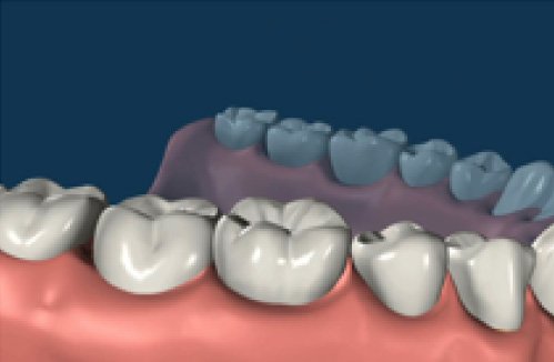 Dental Implant Procedure