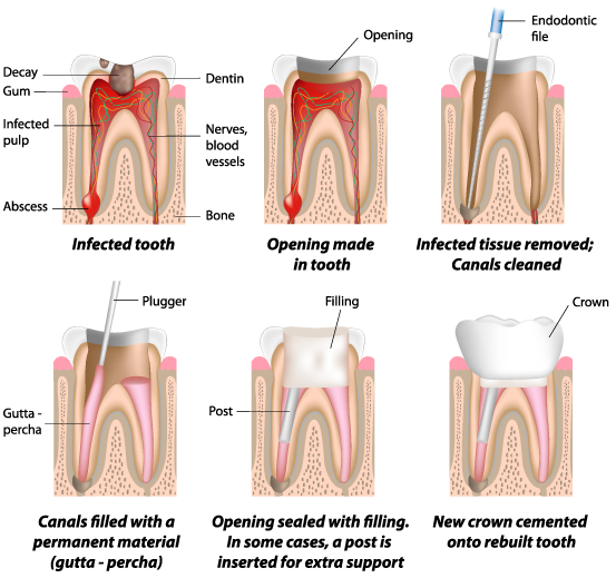 Shoreline Root Canals